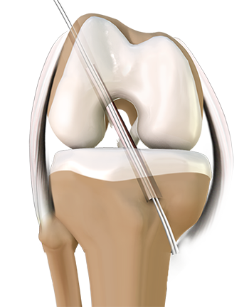 Anterior Cruciate Ligament Reconstruction