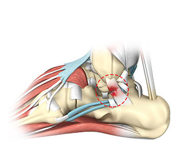 Ankle Sprains:  Is it just a sprain?