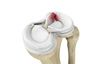 Meniscal Tears in the Knee