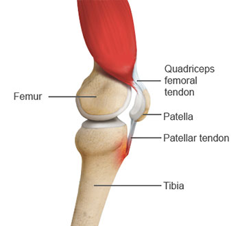 Osgood-Schlatter’s Disease: It sure sounds bad.