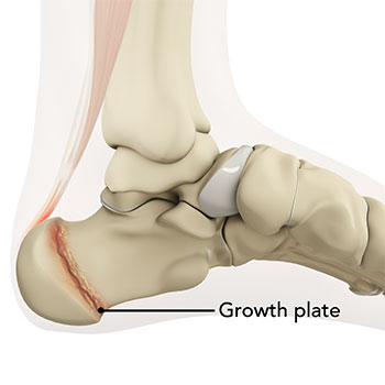 Sever's Disease:  Most common foot pain problem in adolescents