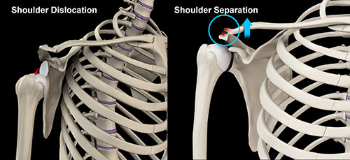 Shoulder Injuries:  Dislocations versus Separations